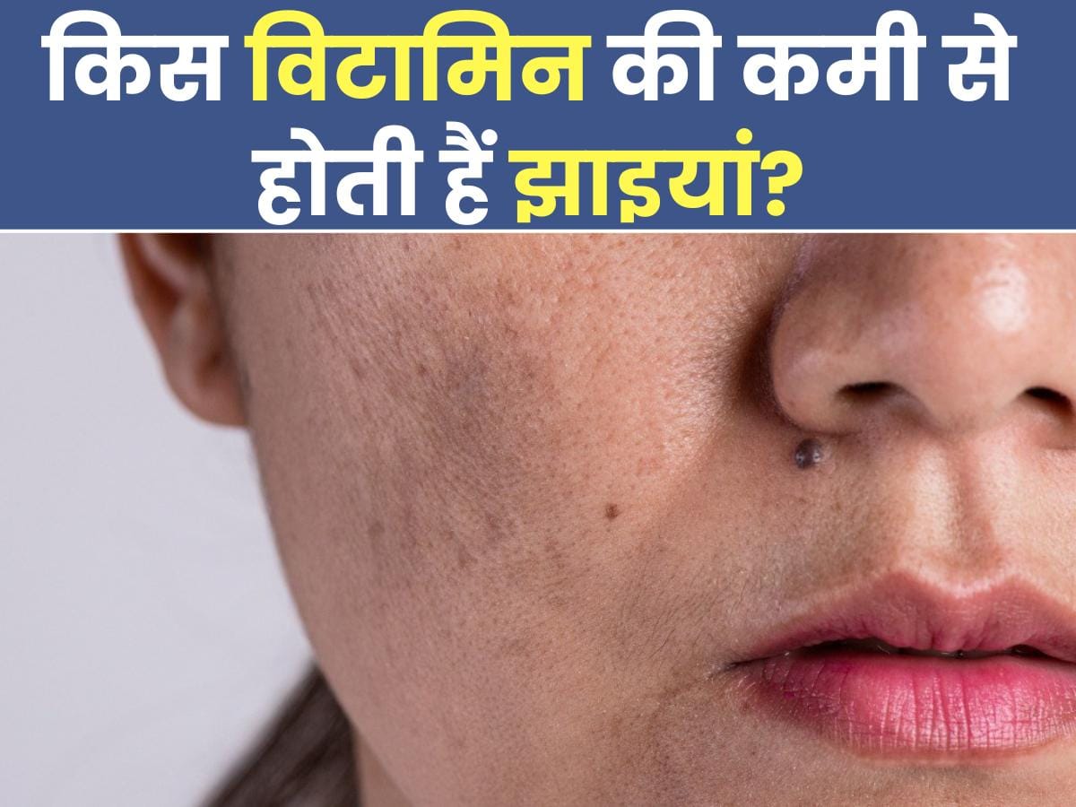 Vitamin Deficiency Cause Pigmentation in Hindi शरीर में इन 4 विटामिन