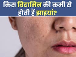 शरीर में इन 4 विटामिन की कमी से भी होती हैं झाइयां, जानिए चेहरे की सुंदरता बढ़ाने वाले पोषक तत्व