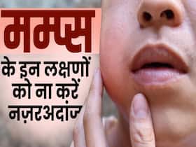 Mumps Symptoms: मंप्स होने पर दिखते हैं ये लक्षण! जानें क्या करें?