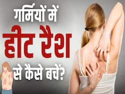 Heat Rashes Treatment: गर्मियों में घमौरियां होने का ये है कारण, जानें क्या है इलाज?