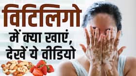 Vitiligo Diet: विटिलिगो के लक्षणों को ऐसे करें कम! डाइट में शामिल करें ये चीजें