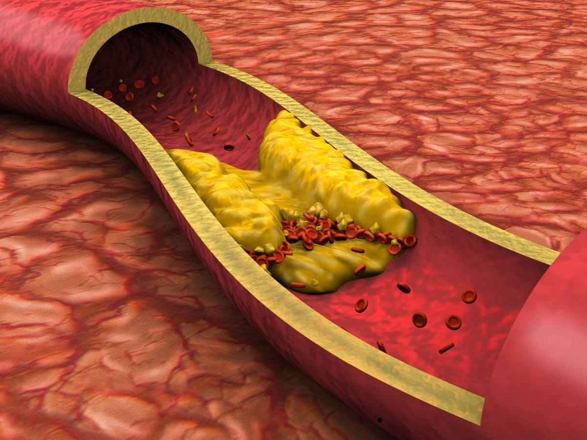 Clogged Arteries: Top 7 Vitamins To Unclog And Clean Heart Arteries 