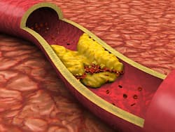 Clogged Arteries: Top 7 Vitamins To Unclog And Clean Heart Arteries Naturally