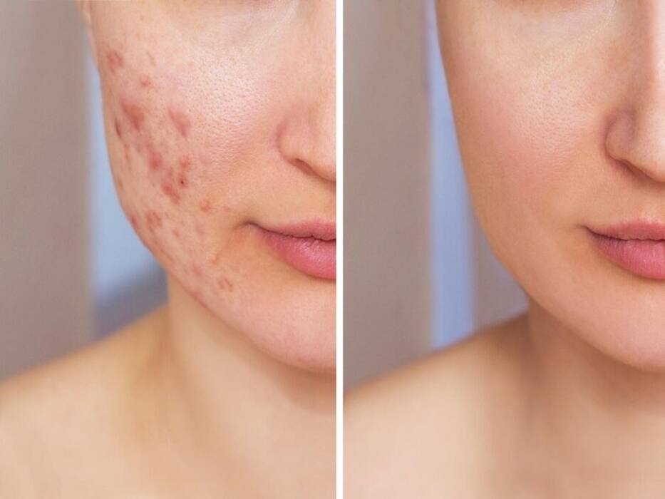 Suffering From Acne Routinely? Here Are Important Things To Know
