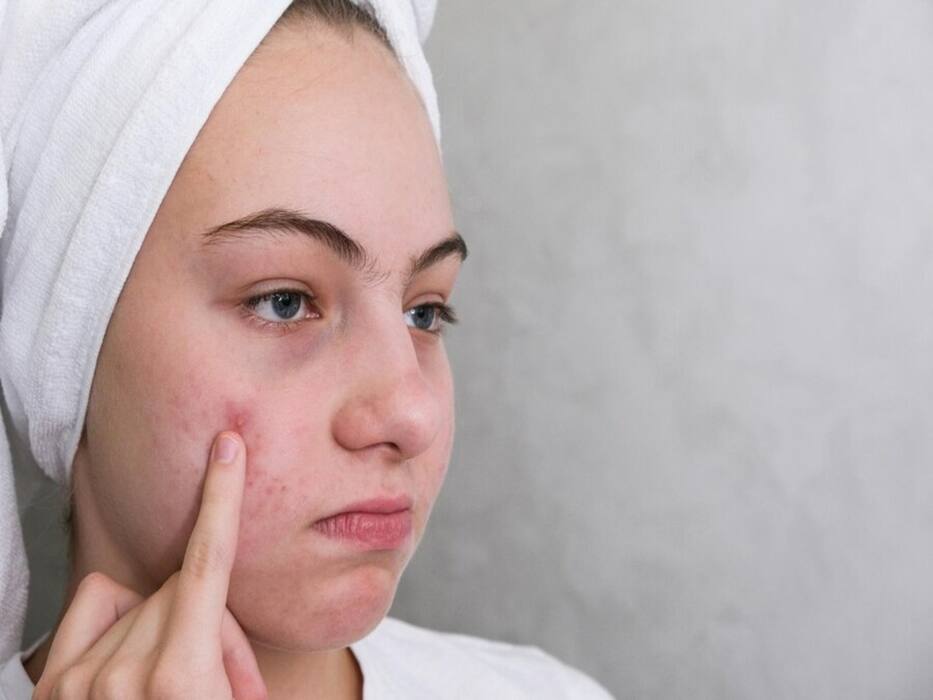 Suffering From Acne Routinely? Here Are Important Things To Know