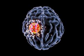 All About Medullabastoma: Why Is It Common In Children?