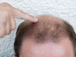 Hairfall Remedies for Men: Top 5 Best Supplements For Men To Stop Extreme Hair Fall