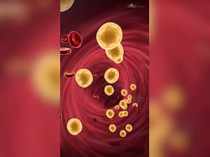 High Cholesterol: 7 Yoga Asanas To Prevent Heatstroke Due To Bad LDL Levels