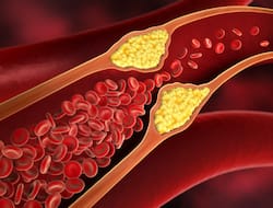 Heart Blockage: 7 Healthy Nighttime Routine To Prevent Heart Attack Due To High Cholesterol Levels