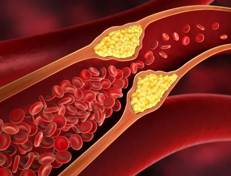 Heart Blockage Management: 7 Healthy Dinner Tips To Prevent Nighttime Heart Attack Due To High Cholesterol Levels