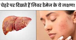 चेहरे पर दिखाई दें ये 5 लक्षण तो समझ जाएं पूरी तरह खराब हो चुका है आपका लिवर, तुरंत भागें डॉक्टर के पास