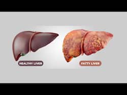 Healthy Liver Vs Fatty Liver: Top Basic Differences  To  Know