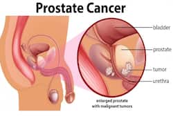 Prostate Cancer: Essential Insights Every Man Should Know About
