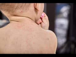 Roseola: A Common Infection That Usually Affects Children By Age 2