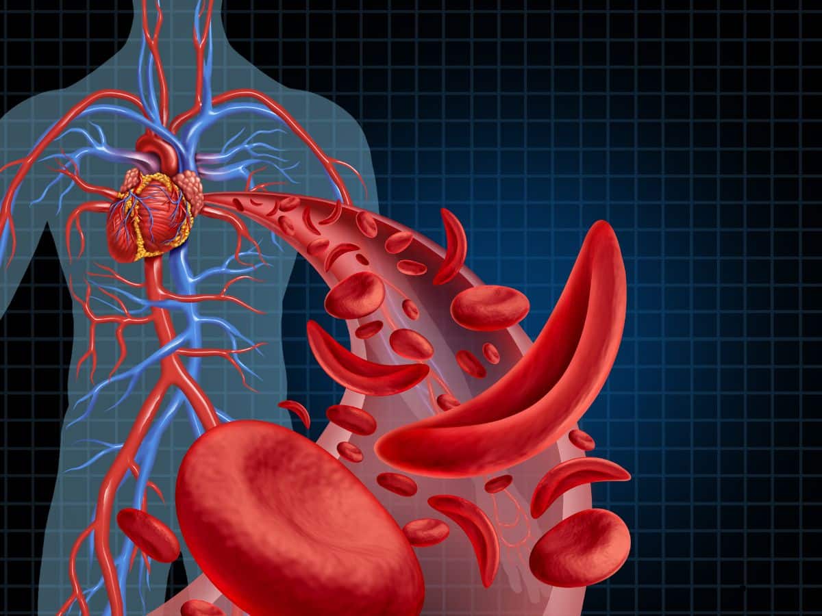 World Sickle Cell Day 2024: 6 Early Symptoms of Sickle Cell Disease To Look Out For
