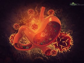 Heartburn to Black Stool: Top 5 Warning Symptoms of Stomach Cancer You Should Know Heartburn to Black Stool: Top 5 Warning Symptoms of Stomach Cancer You Should Know