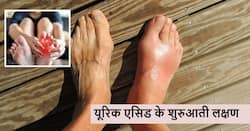 शरीर में देखे जाने वाले ये 5 शुरुआती लक्षण जो हो सकते हैं हाई यूरिक एसिड के लक्षण, गलती से भी न करें इग्नोर