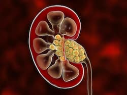 किडनी स्टोन का बन जाएगा चूरा, दर्द भी होगा दूर, रोजाना खाएं घर के ये कुछ हेल्दी फूड