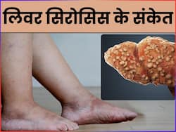 शरीर में दिखने वाले ये 5 संकेत लिवर सिरोसिस की ओर करते हैं इशारा, समय रहते करें पहचान