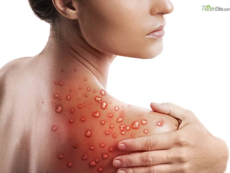 Are You Suffering From Vitamin B6 Deficiency? Look Out for These 7 ...
