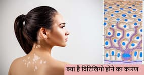 Vitiligo Day 2024: स्किन एक्सपर्ट से जानिए शरीर में किस चीज की कमी होने के कारण होने लगता है विटिलिगो