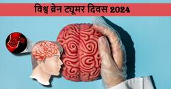किसी भी उम्र में कभी भी हो सकता है ब्रेन ट्यूमर, डॉक्टर ने बताई इन सावधानियों को बरतना बहुत जरूरी