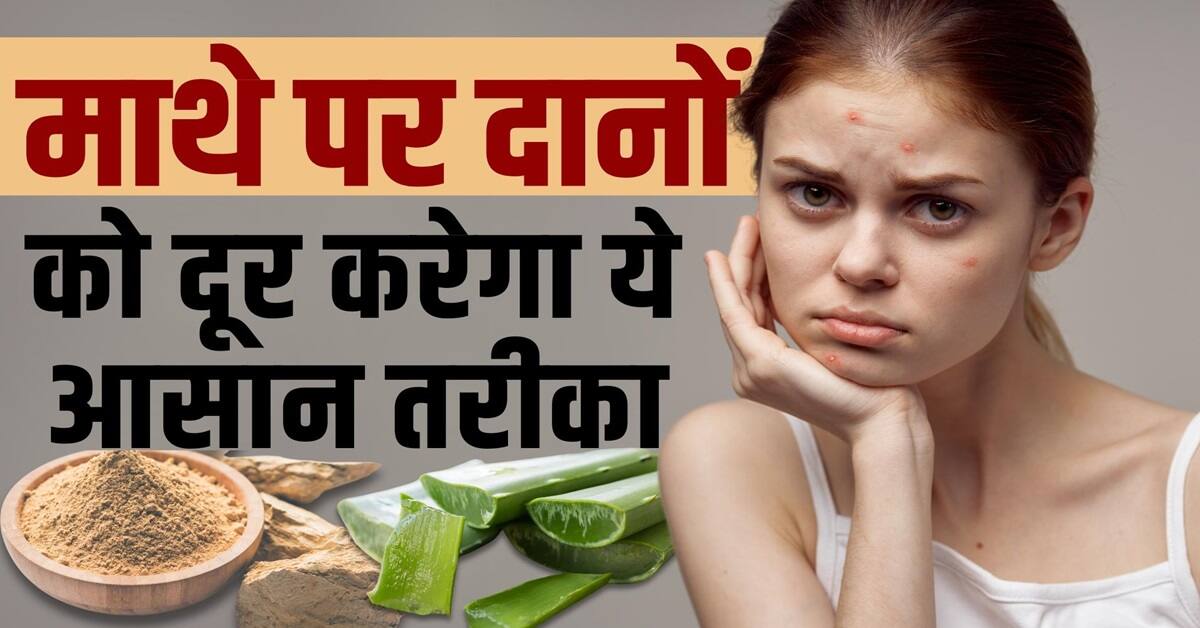 Heat Rashes Remedies: गर्मी के मौसम में माथे पर दाने हो गए हैं तो इन ...