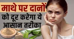 Heat Rashes Remedies: गर्मी के मौसम में माथे पर दाने हो गए हैं तो इन टिप्स को फॉलो करें