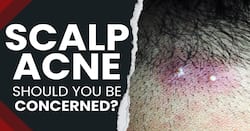 Acne Prevention Tips: Is Scalp Acne a matter of concern? | Know the Cause