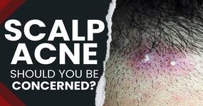 Acne Prevention Tips: Is Scalp Acne a matter of concern? | Know the Cause