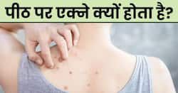 पीठ पर पिंपल्स और एक्ने होने के पीछे की हो सकती है ये वजह, इन 3 उपायों से करें इसका इलाज 