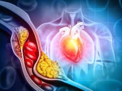 High Cholesterol Control Tips: 7 Morning Routines That Can Help Lower LDL Cholesterol Levels During Summer