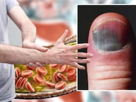 Clogged Arteries Symptoms In 30s: Top 7 Unusual Signs of Blocked Heart Arteries In Fingers
