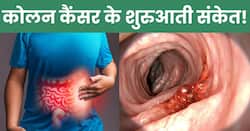 कोलन कैंसर के शुरुआत होते ही शरीर देने लगता है ये 5 संकेत, 99 फीसदी लोग करते हैं इग्नोर