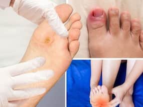 Diabetes Warning Symptoms: 7 Signs of High Blood Sugar Levels In Feet And Heel At Night