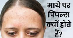 माथे पर एक्ने होने के क्या कारण हो सकते हैं? जानें छुटकारा पाने के आसान उपाय