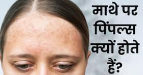 माथे पर एक्ने होने के क्या कारण हो सकते हैं? जानें छुटकारा पाने के आसान उपाय