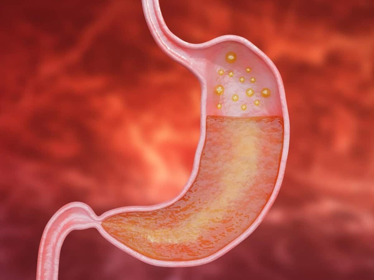 What is stomach cancer?