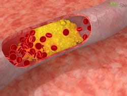 High Cholesterol: Top 5 Superfoods To Lower LDL Cholesterol In Monsoon