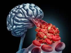 Clogged Arteries In Brain Symptoms: 7 Unusual Signs of Nighttime Stroke That Appears Only At Night