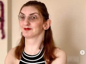 Guinness Recognition: Meet Rumeysa Gelgi, World's Tallest Woman With The Longest Ears