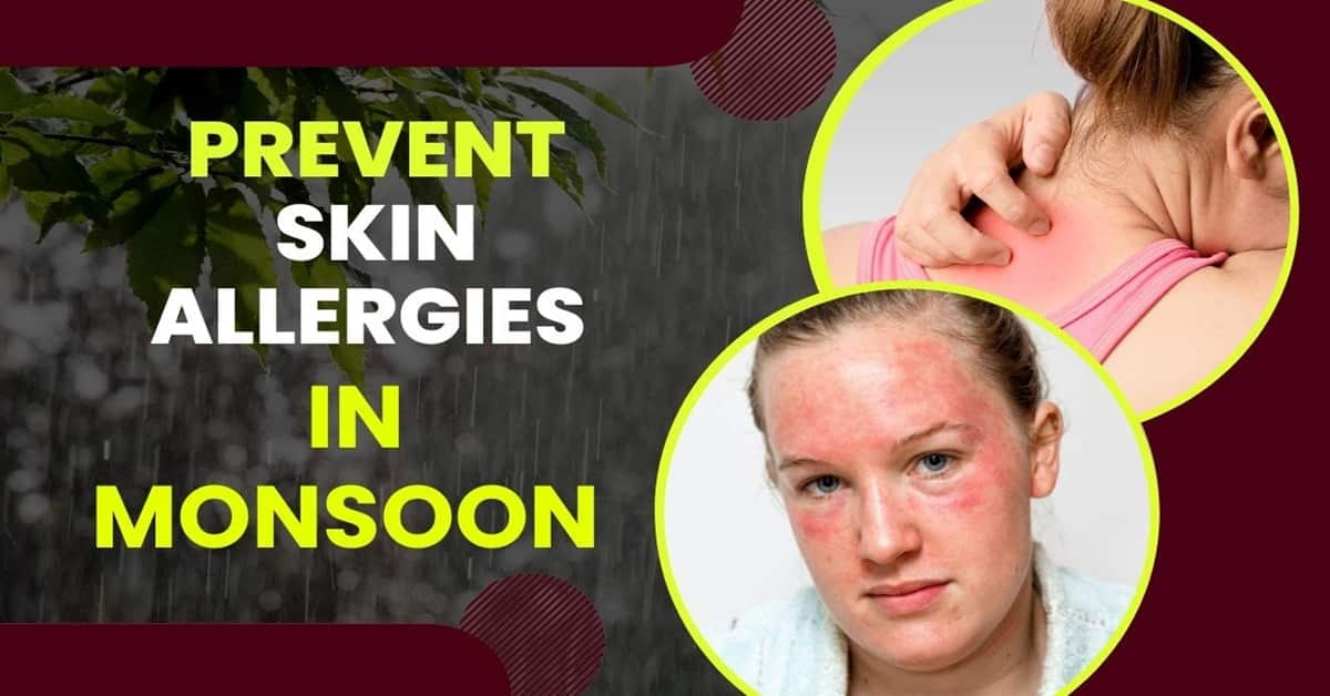 Monsoon Season: Understanding Skin Allergies And Effective Prevention