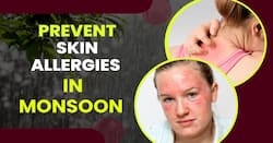 Skin Allergies During Monsoon: Stay informed about common skin allergies during monsoon