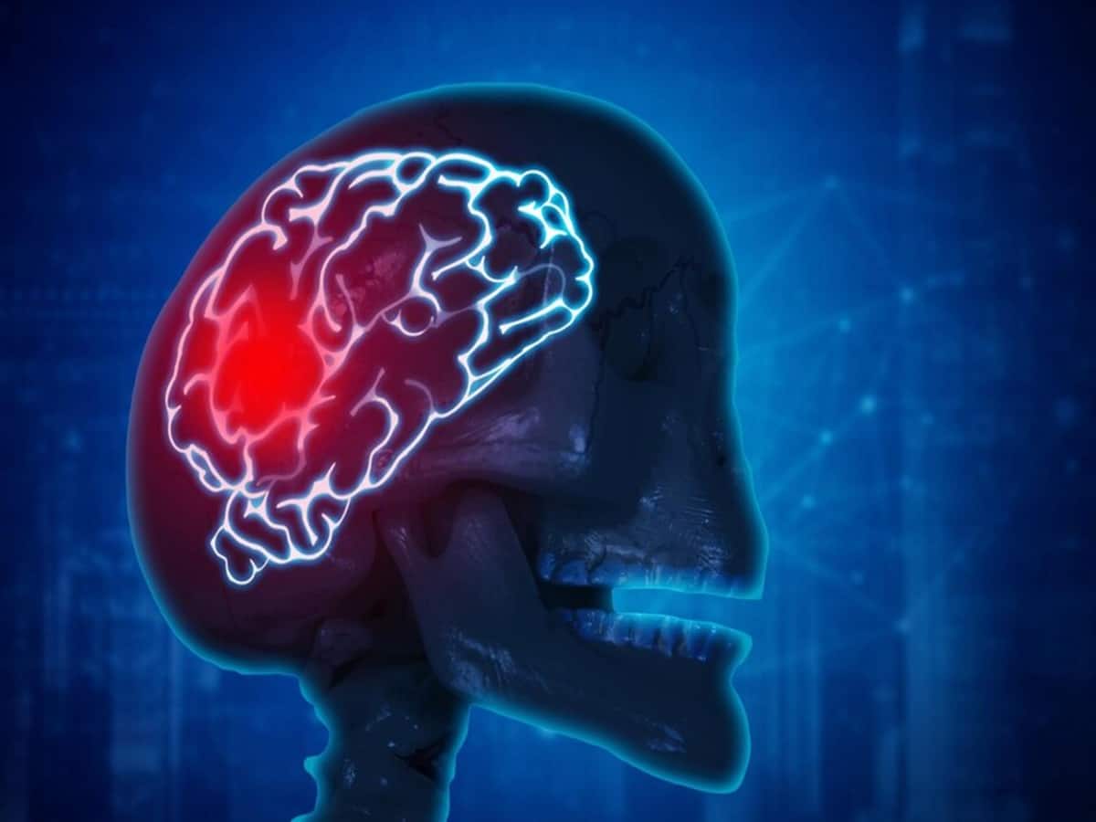 Stroke Risk: Can Genetic Factors, Ethnicity And Regional Disparities In ...