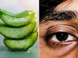 Can Aloe Vera Gel Treat Dark Circles?