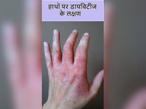 हाथों के इन 7 संकेतों से समझ जाएं 400 के पार पहुंच चुका है ब्लड शुगर