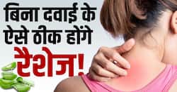 Heat Rashes Home Remedies गर्मियों में हीट रैशेज का ऐसे करें इलाज! देखें वीडियो