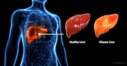 विश्व हेपेटाइटिस दिवस 2024: हेपेटाइटिस की बीमारी ले सकती है घातक रूप, सतर्कता बहुत जरूरी