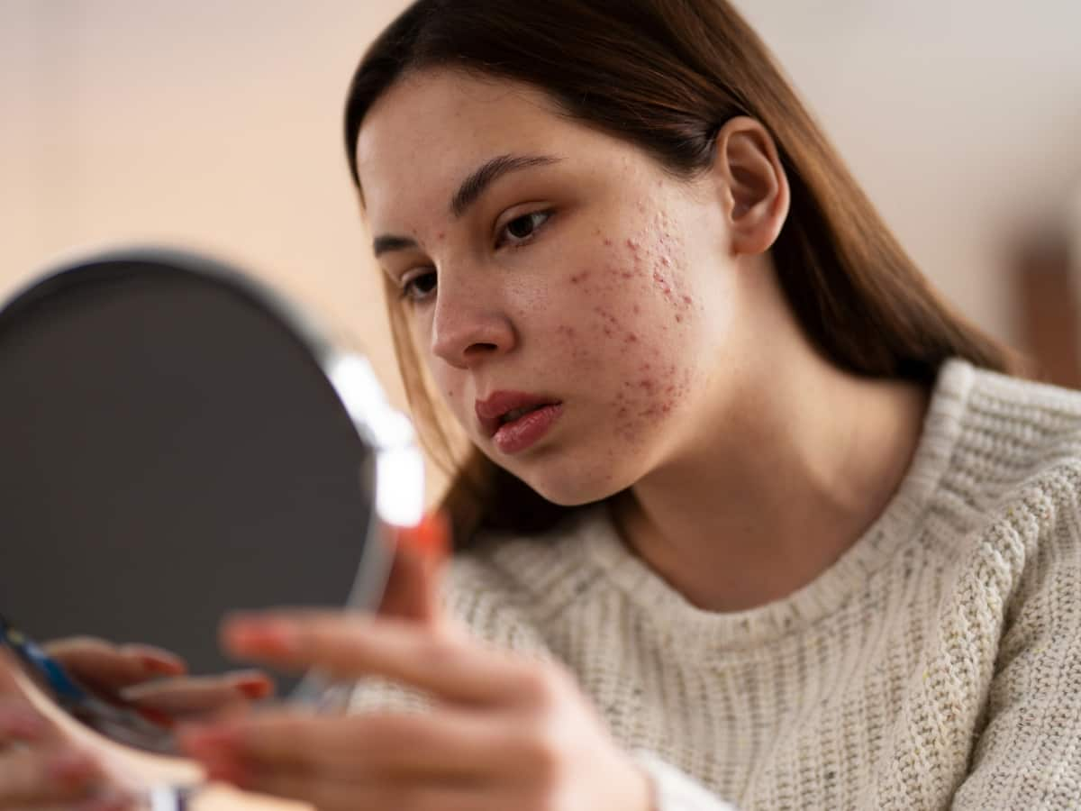 5 Lifestyle Changes To Get Rid Of Pimples In 4 Weeks