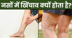 नसों में खिंचाव क्यों होता है?  जानिए कम करने के तरीके